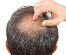 为什么脱发都是从头顶开始的