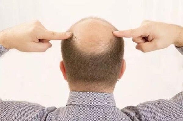 中医能不能治疗脂溢性脱发
