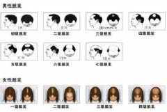 脱发等级的划分