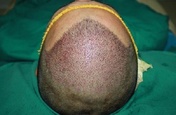 植发手术后应该要注意些什么