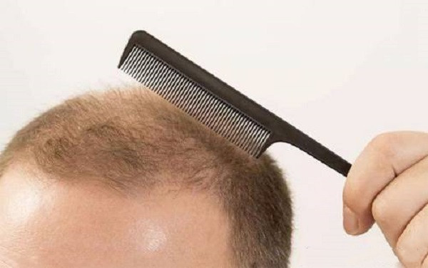 怎么治疗脂溢性脱发才会有效