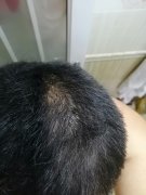 因为脱发我失去了她，幸好遇见了增发纤维