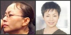 为什么那么多明星都不做植发