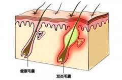 毛囊如何生发