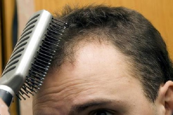 植发有没有年龄限制