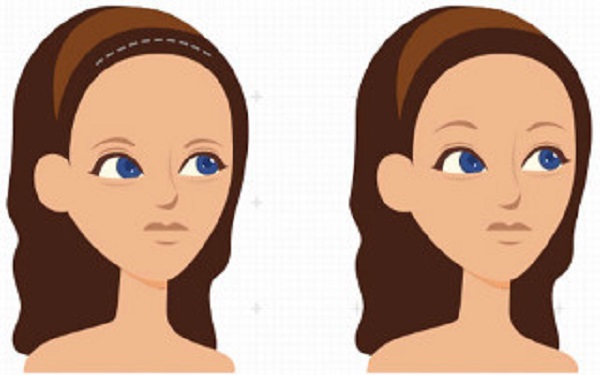 植发以后头发要过多久才能长出来