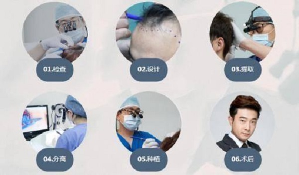 植发分为几个部分