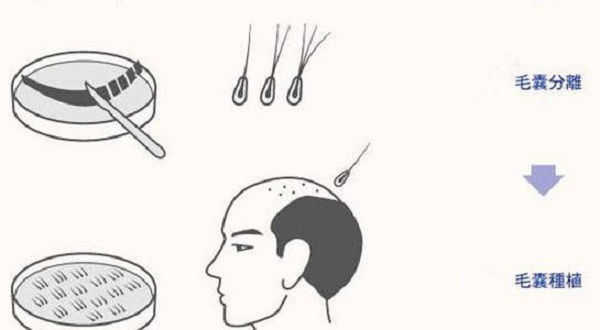 植发的特点有哪些