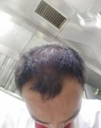 脱发应急的神器：增发纤维