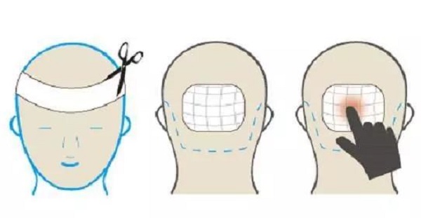 植发手术以后要注意什么事项
