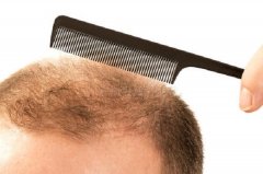 脱发有可能暗示的疾病