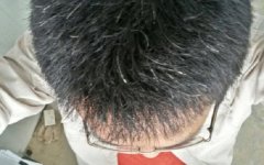 头发变白是什么原因