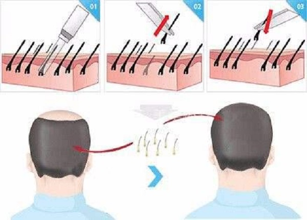 植发有哪些好处