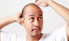 怎么才能知道自己是否脱发