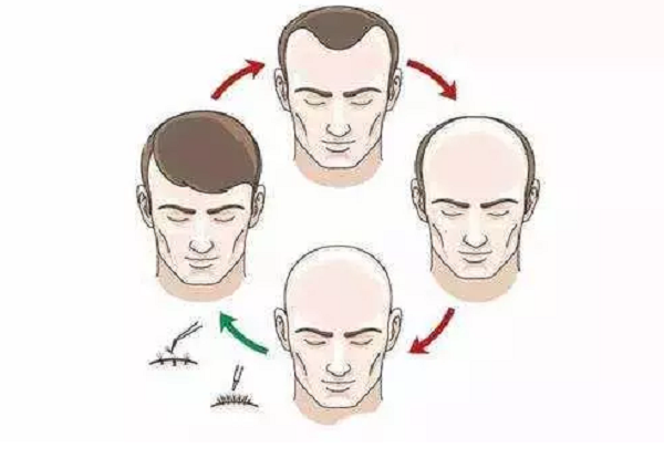 植发以后多久会长出来头发