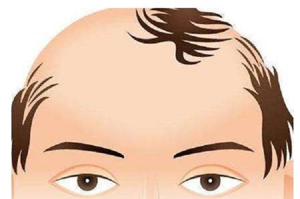 植发后头皮发痒应该要怎么办