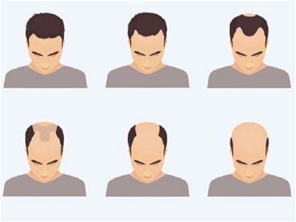 常见的脱发类型有哪些