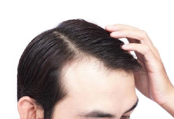 男性应该怎么治疗脱发