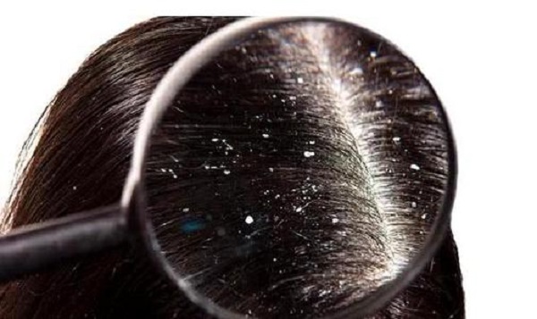 为什么刚洗完头还会有头皮屑