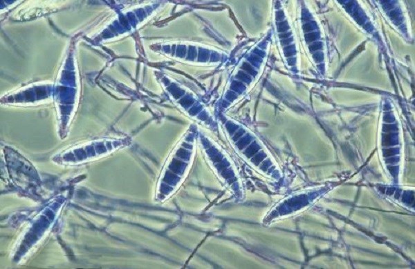 头皮里起癣该怎么办