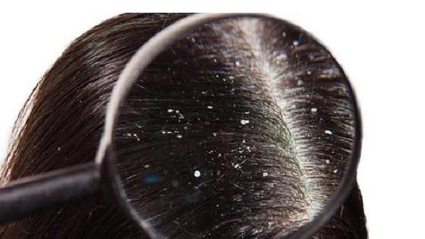 头皮屑多应该要怎么办