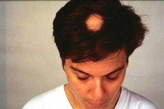 鬼剃头出现的原因是什么