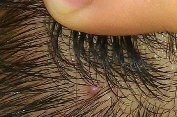 头皮长疙瘩是怎么回事