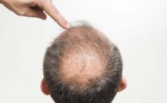 气血不足导致的脱发应该吃什么