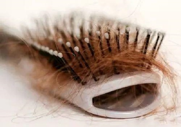 头皮屑多会不会导致脱发