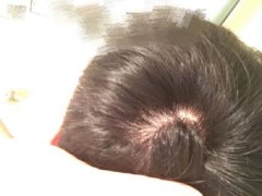 头皮发炎应该怎么办