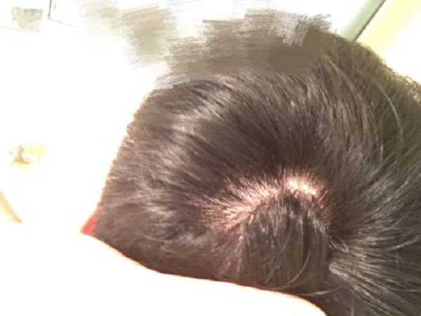 头皮发炎应该怎么办