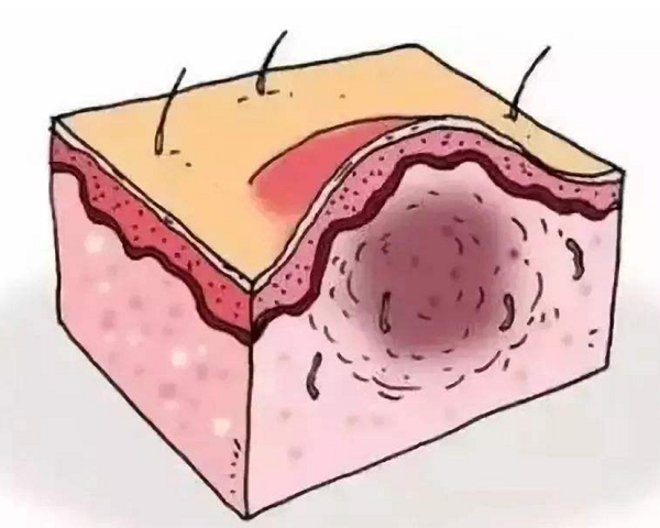 头皮发炎应该怎么办