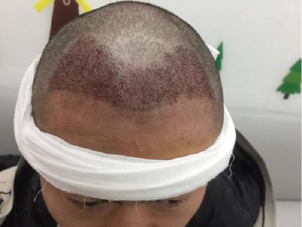 植发后需要休息多久时间