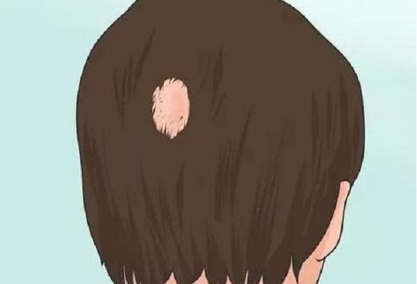 斑秃真的会自愈吗
