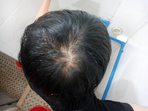 男性脱发都是什么原因引起的?——遗传性脱发