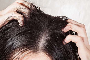 脂溢性脱发的表现有哪些？——掉发太明显