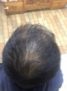 有了增发纤维之后我就再也不担心头发了