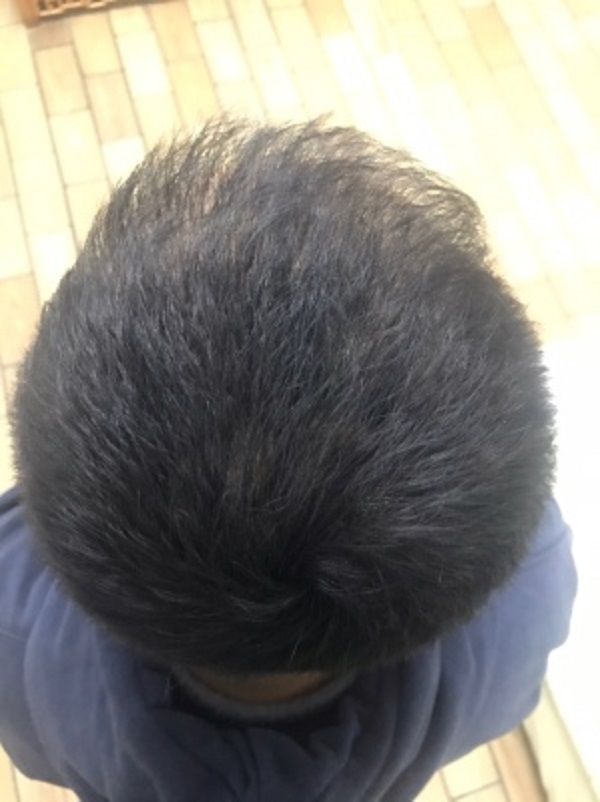 有了增发纤维之后我就再也不担心头发了