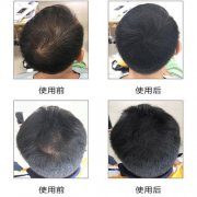 头发稀疏怎么办？增发纤维来帮忙