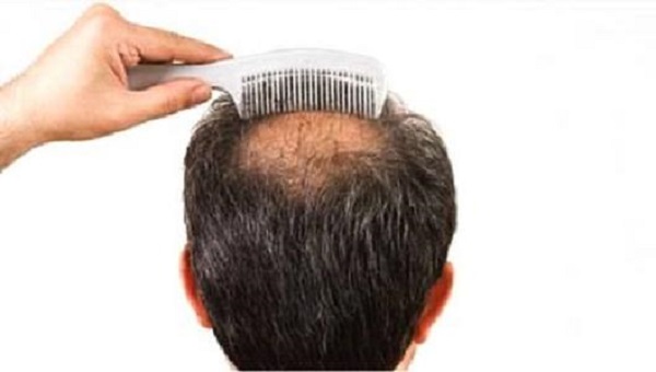 植发手术之后吃什么比较好