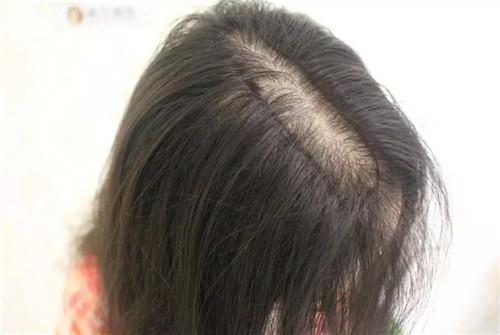 女孩头发发痒是什么原因？应该怎么办？