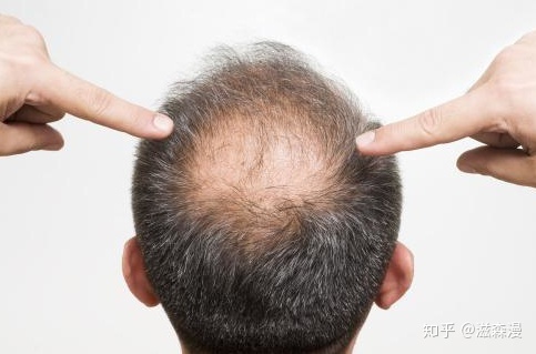 脂溢性脱发有治疗好的可能吗