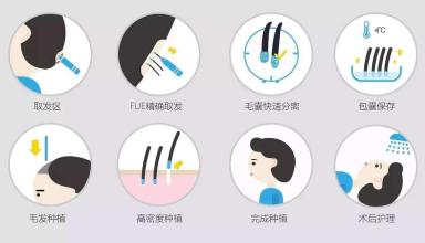 现在植发都有哪些技术