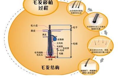 现在植发都有哪些技术
