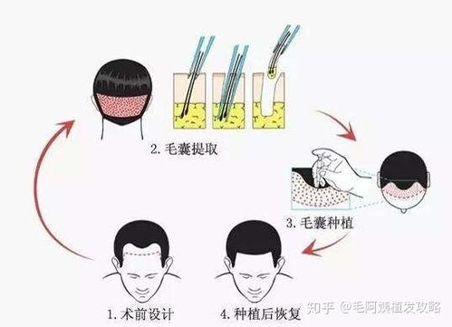 现在植发都有哪些技术