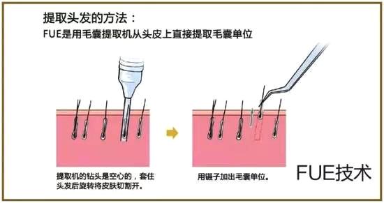 现在植发都有哪些技术