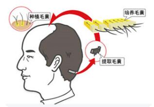 影响植发价格的都有什么因素