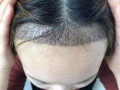 植发后是否会有后遗症？