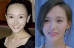 染头发会导致发际线后移吗？