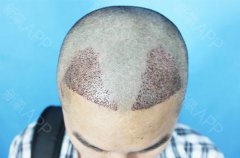 植发手术后后枕部头发会变少吗？